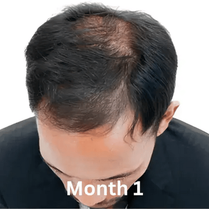 Hair Regrowth Oil & Hair growth Shampoo (Free)
